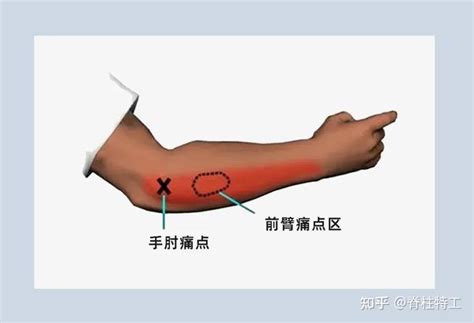 手掌小拇指下方痛|『手部疼痛地图』教你对图自查！